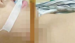 Mẹ bất ngờ phát bệnh tâm thần đâm bút chì vào cổ con gái 8 tuổi